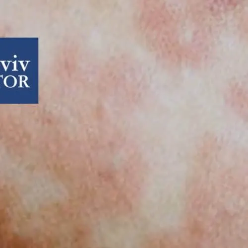 Measles Israel Outbreak Measles Outbreak in Israel: Medical Facts