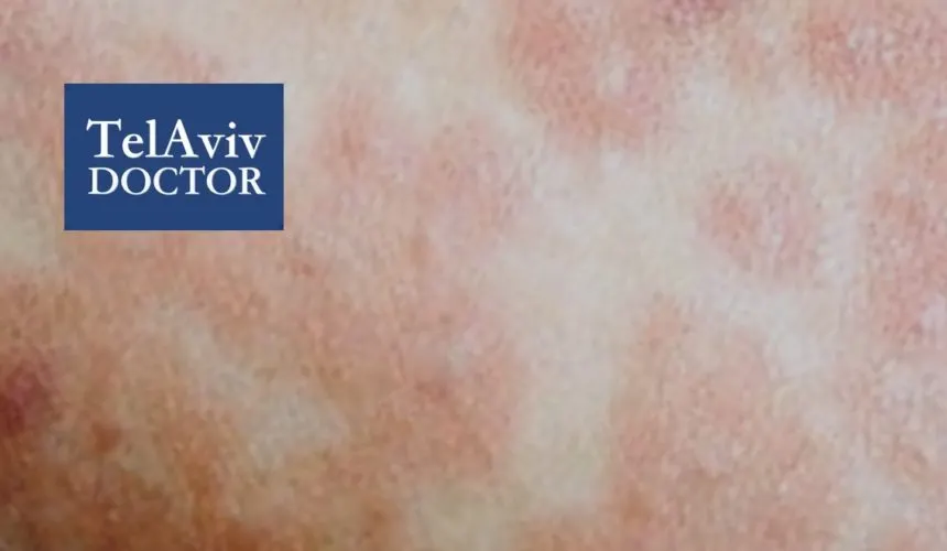 Measles Israel Outbreak | Tel Aviv Doctor Measles Outbreak In Israel Health Advice | Tel Aviv Doctor - Part 2